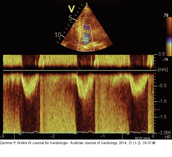 LVOT