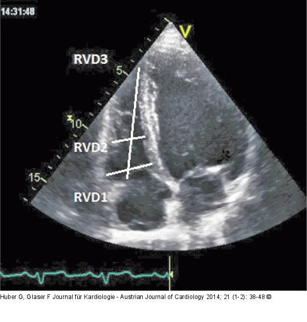 Rechtsherzdilatation
