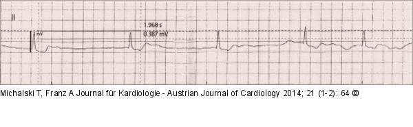 Bradyarrhythmie