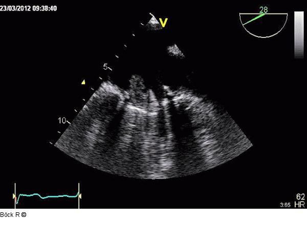TEE - Thrombus