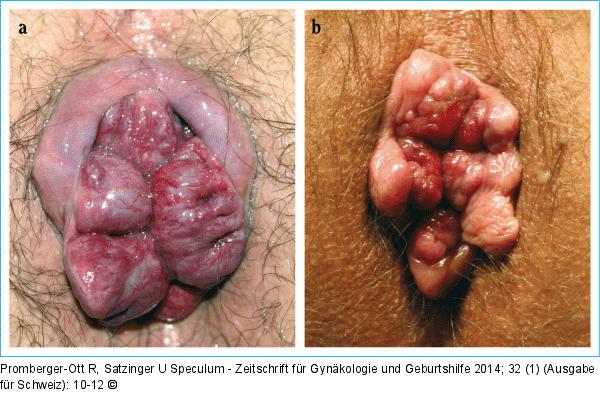 Hmorrhoiden