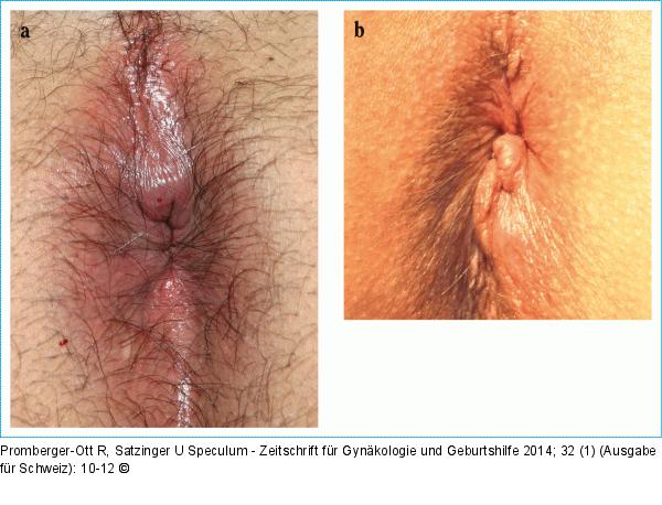 Hmorrhoiden