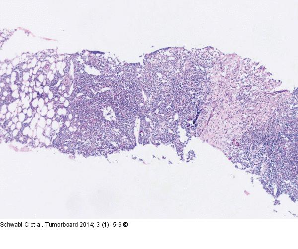 Follikulres Lymphom