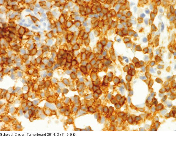 Follikulres Lymphom
