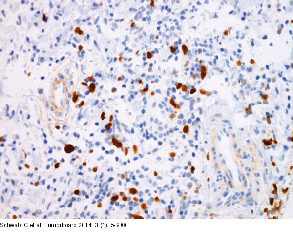 Follikulres Lymphom