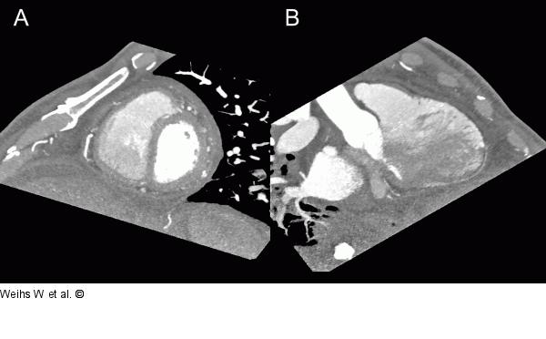 Cardiac CT