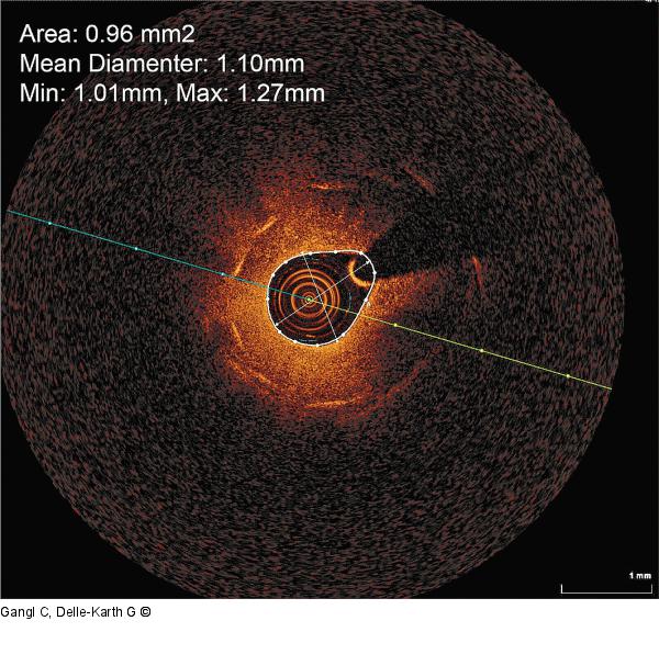 In-Stent-Restenose