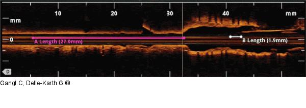 OCT - In-Stent-Restenose