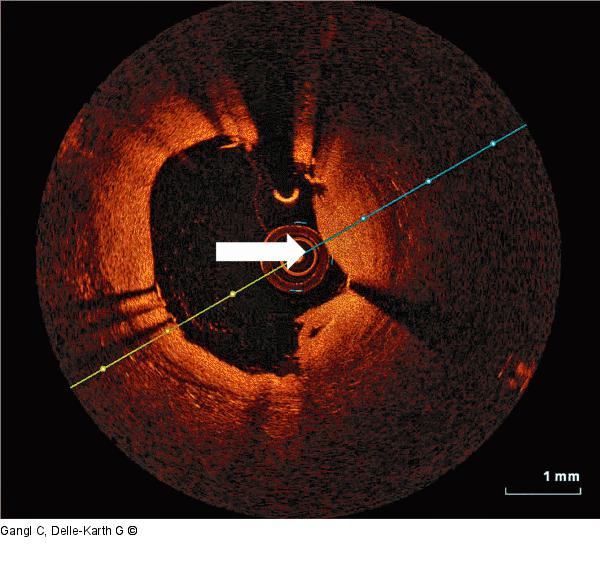 Thrombus - In-Stent-Restenose