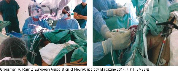 Awake Craniotomy