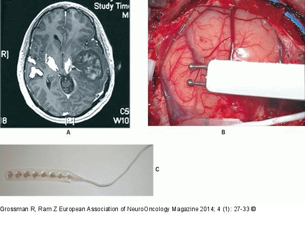 Awake Craniotomy