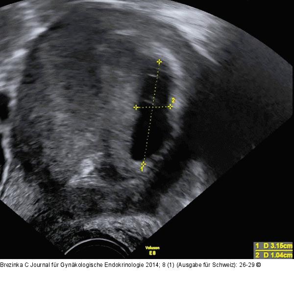 Gyn-Ultraschall
