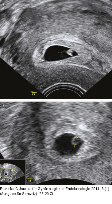 Gyn-Ultraschall