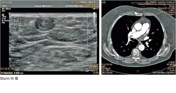 Venenthrombose