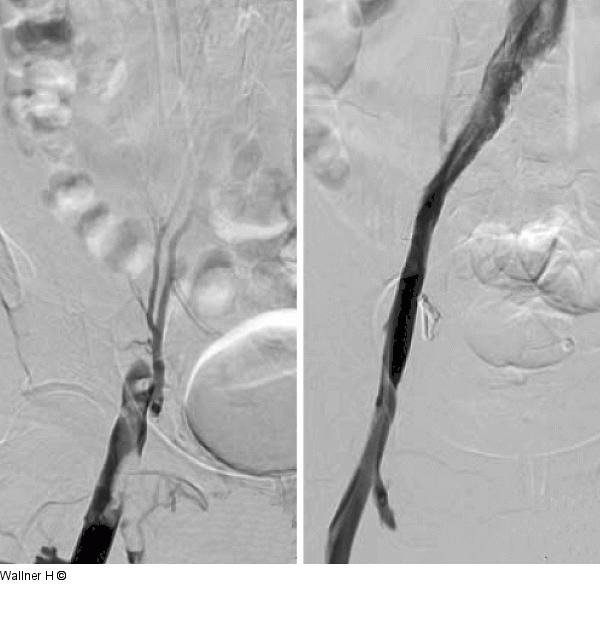 Thrombose