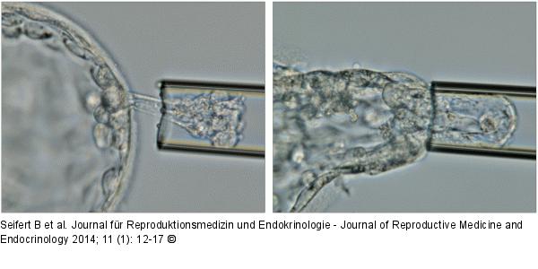 Trophoblastbiopsie