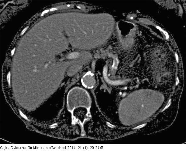 Renale Osteodystrophie