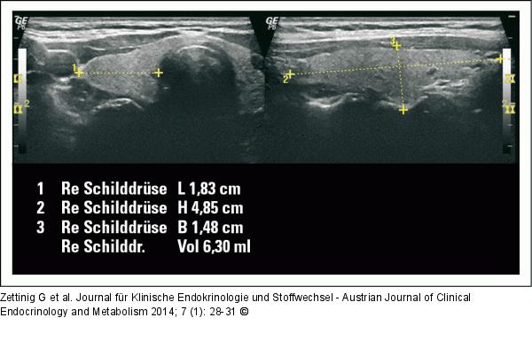 Schilddrse - Rechter Lappen