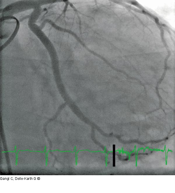 Angiographie - CX
