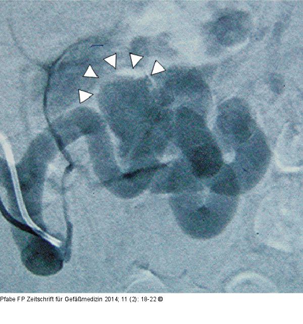 Sacciformes Aneurysma