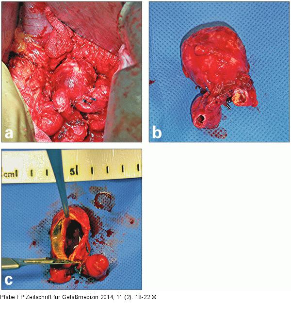 Sacciformes Aneurysma