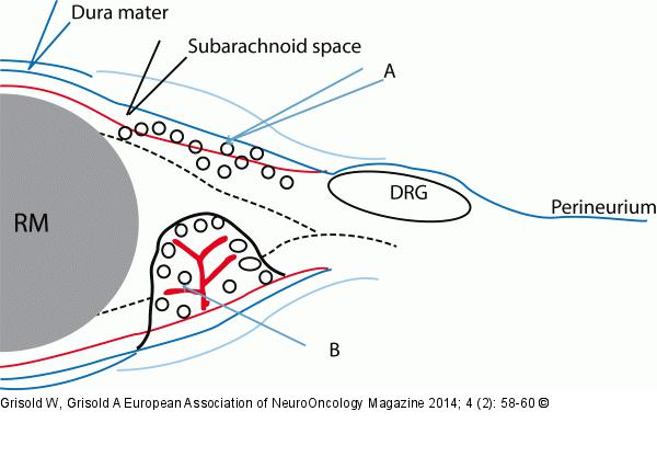 Meningeal infiltration