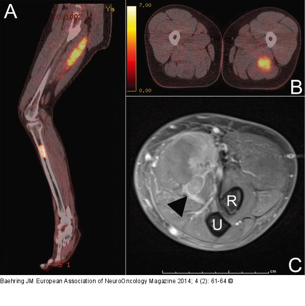Mantle cell lymphoma