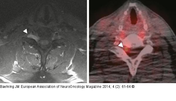 Primary neurolymphomatosis