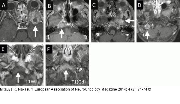 Skull-base metastases