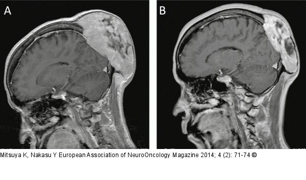 Calvarial metastasis