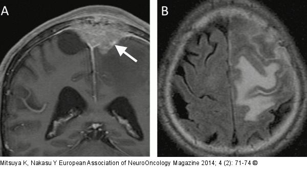 Calvarial metastasis