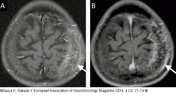Calvarial metastasis