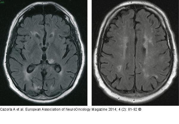 Brain-Lymphoma