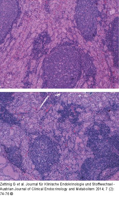 Chronische Immunthyreoiditis