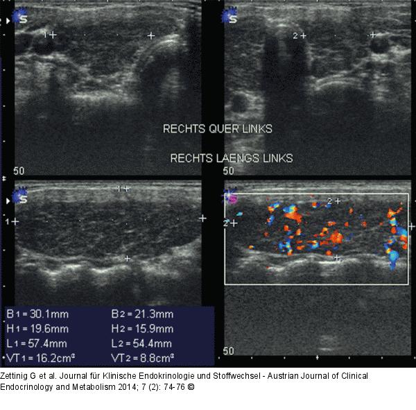 Chronische Immunthyreoiditis