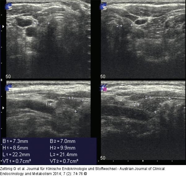 Chronische Immunthyreoiditis