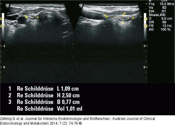 Chronische Immunthyreoiditis