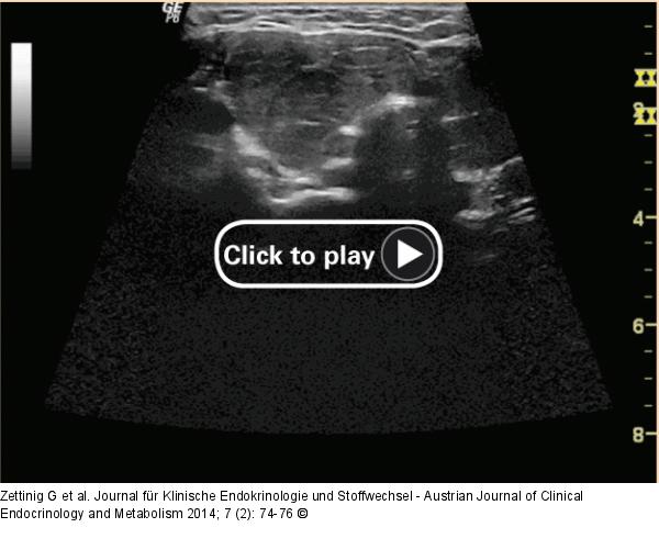 Chronische Immunthyreoiditis