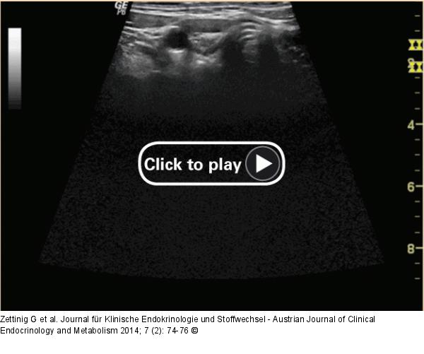 Chronische Immunthyreoiditis