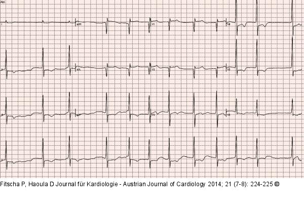 EKG