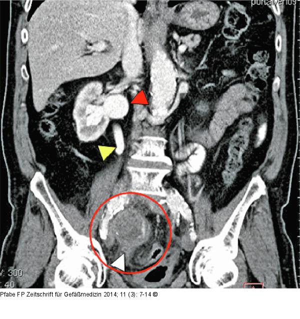 Iliakalaneurysma