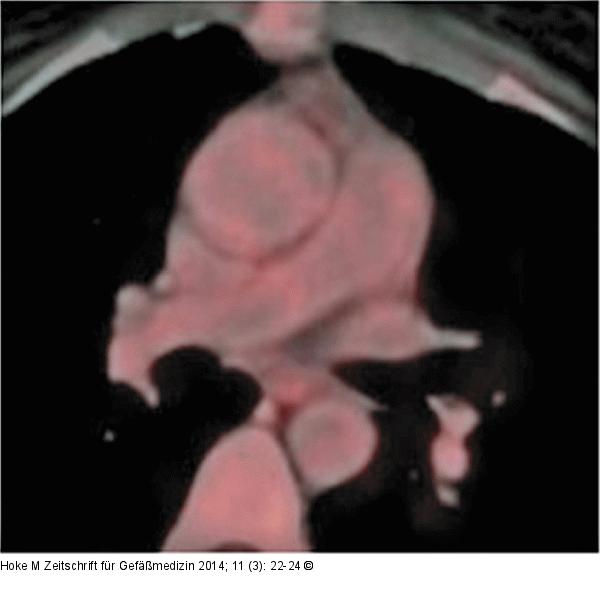 PET-CT