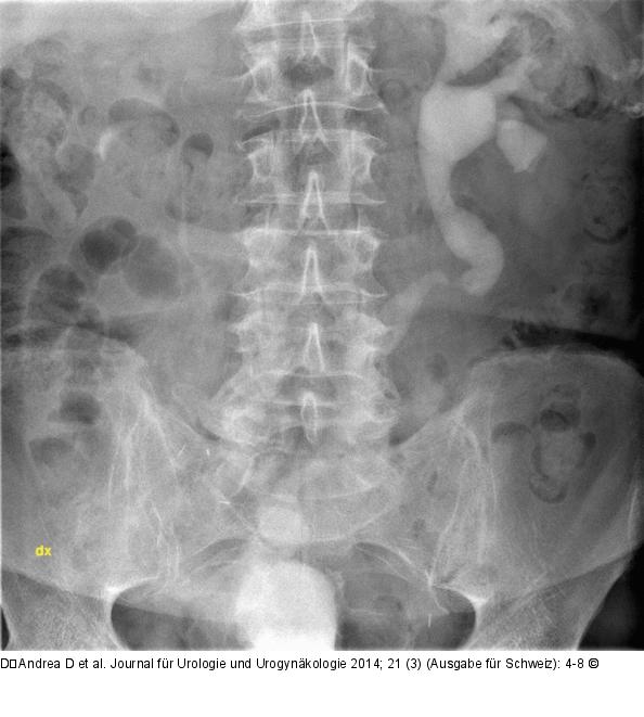 Implantationsstenose