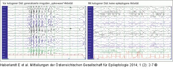 EEG - Ketogene Dit