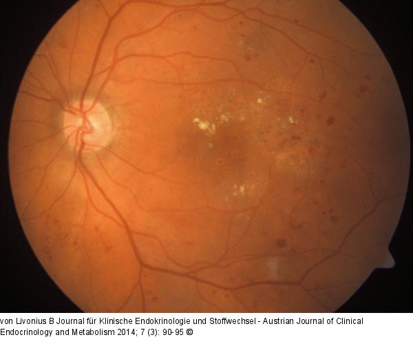 Diabetische Retinopathie