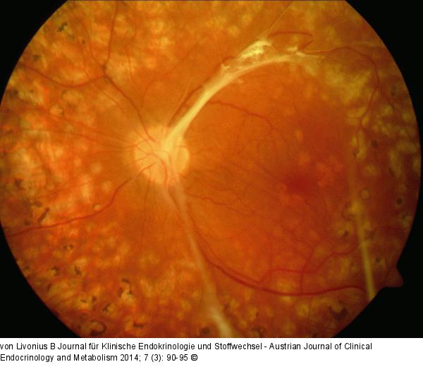 Diabetische Retinopathie