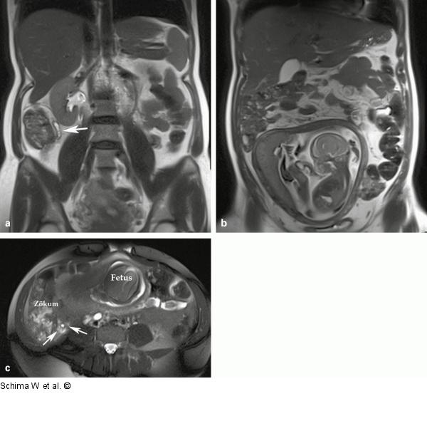 Appendizitis-Diagnose