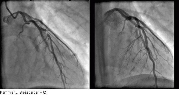 Angiogramm