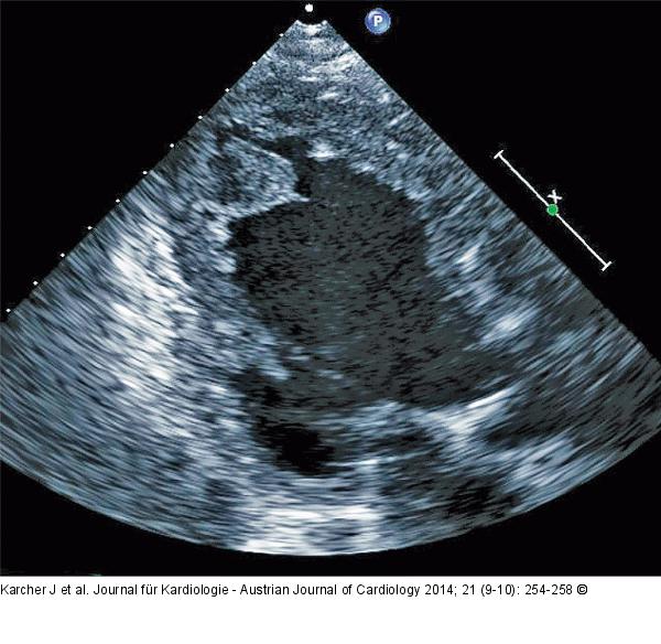 Thrombus