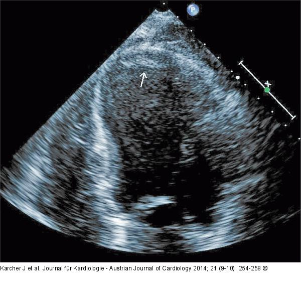 Thrombus